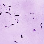 Tuberculosis kills 1.23 million people last year, WHO says