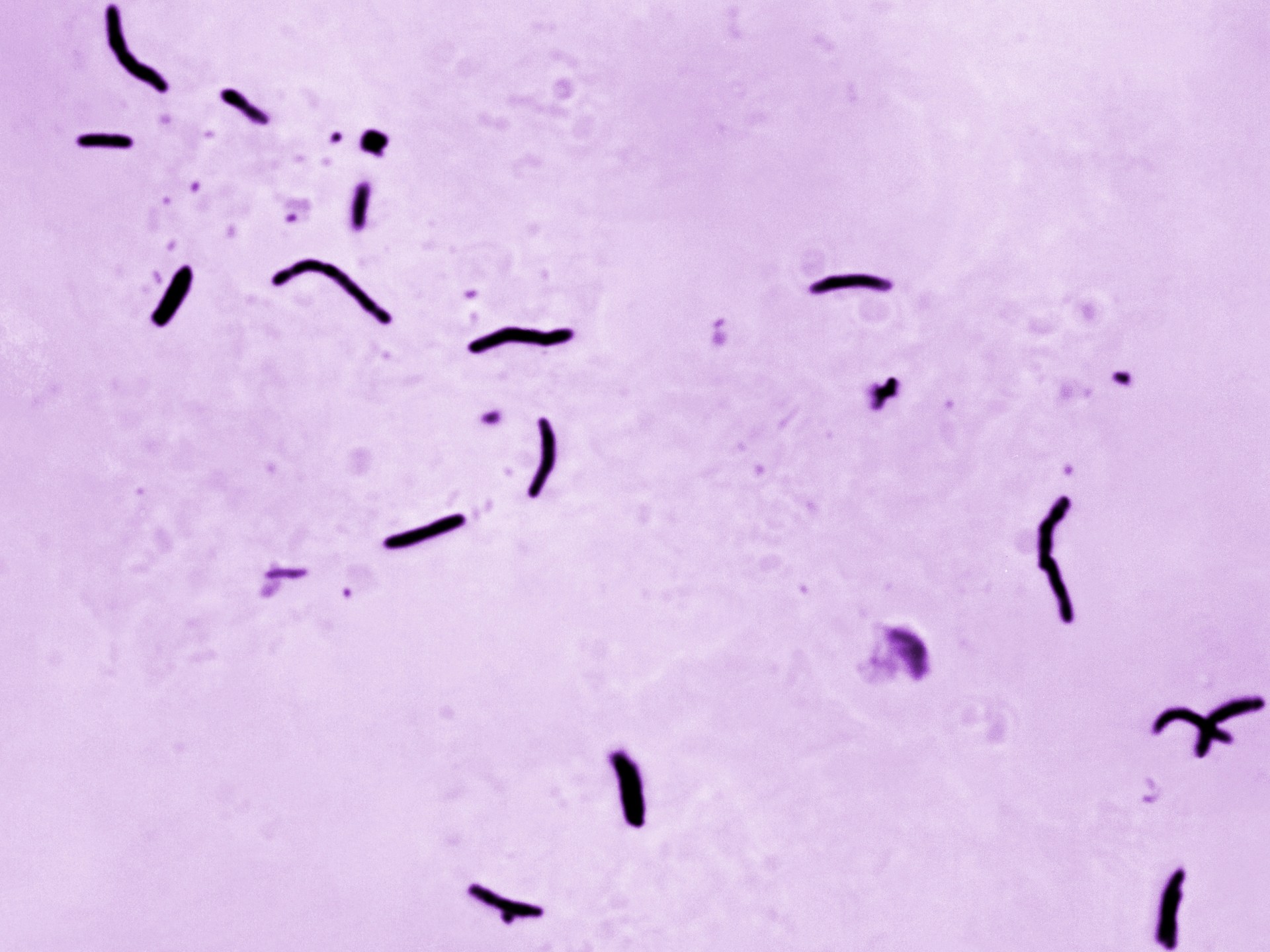 Tuberculosis kills 1.23 million people last year, WHO says